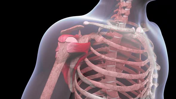 VideoHive Shoulder Injury With Small Crescent Tear Of The Rotator Cuff 34256444